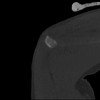 SPORK, NICO - 22.03.1976 - 02.08.2022 - CT obere Extremität - 17:59:07